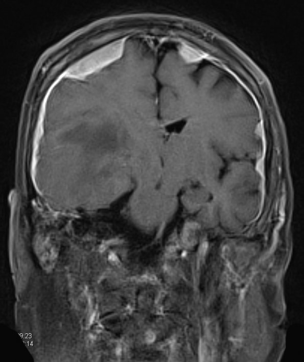 15A3 Metastasis, meninges, prostate (Case 15) dura T1 W 6 - Copy - Copy