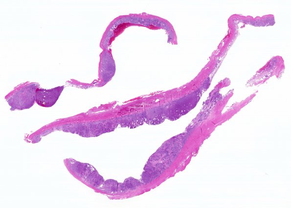 15B1 Metastasis, meninges, prostate (Case 15) dura H&E WM