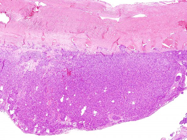 15B2 Metastasis, meninges, prostate (Case 15) H&E 3.jpg