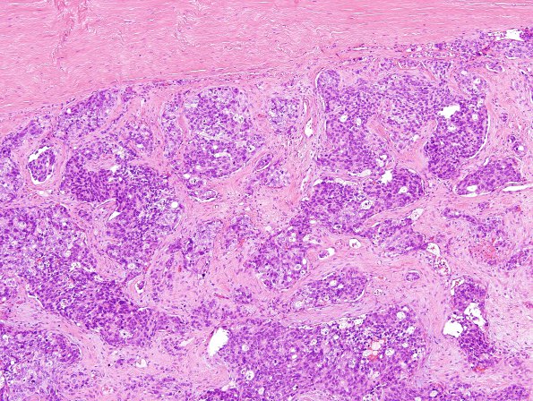 15B3 Metastasis, meninges, prostate (Case 15) H&E 4.jpg