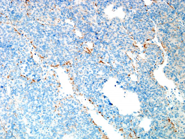 15C1 Metastasis, meninges, prostate (Case 15) dura PSA 2.jpg