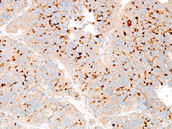 15C4 E2 Metastasis, meninges, prostate (Case 15) dura Prostein1.jpg