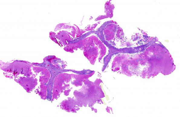 16A1 Metastasis, lung, lepto (Case 16) H&E WM