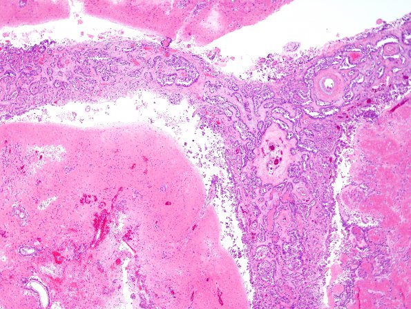 16A2 Metastasis, lung, lepto (Case 16) H&E 8.jpg