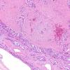 16A3 Metastasis, lung, leptomeninges (Case 16) H&E 11.jpg