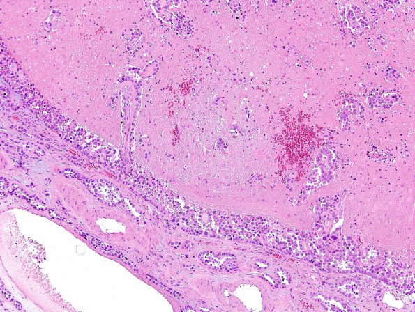 16A3 Metastasis, lung, leptomeninges (Case 16) H&E 11.jpg