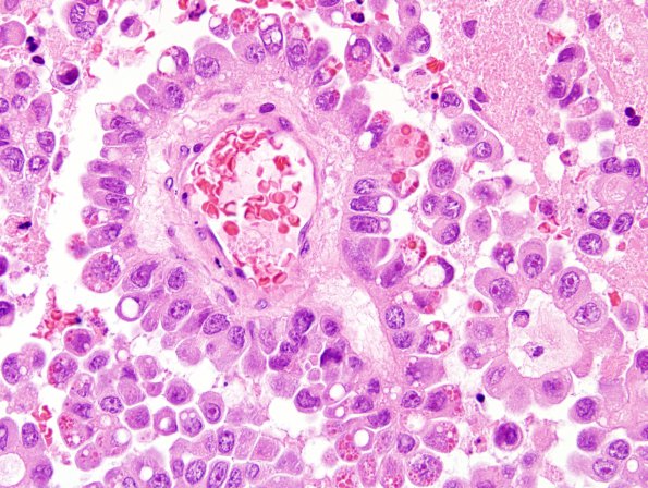 16A4 Metastasis, lung, lepto (Case 16) H&E 1.jpg