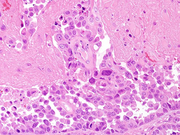 16A5 Metastasis, lung, lepto (Case 16) H&E 2.jpg