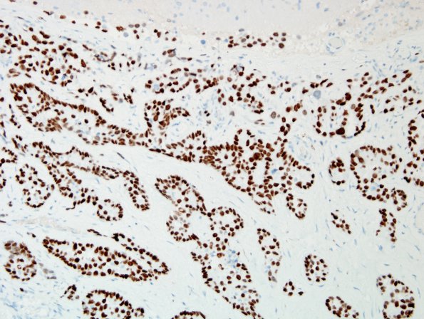 16B3 Metastasis, lung, lepto (Case 16) TTF1 1.jpg