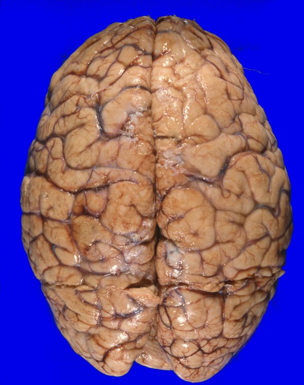 1A1 Metastases, Lung primary (Case 1) X 8