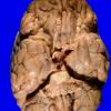 1A3 Metastases, Lung primary (Case 1) X 13