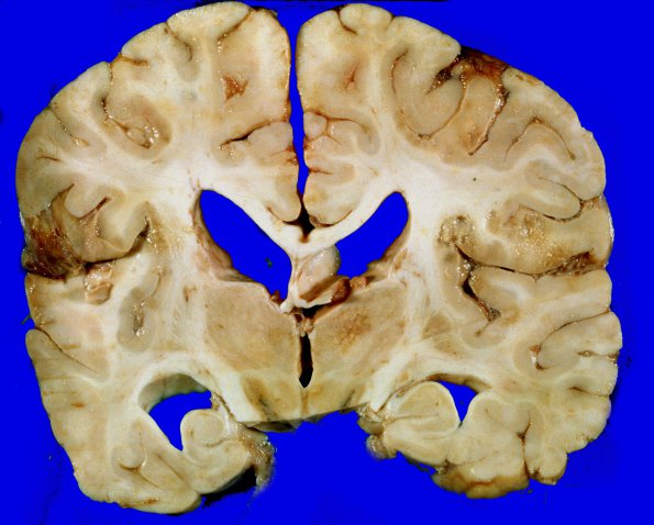 1A5 Metastases, Lung primary (Case 1) X 3