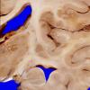 1A6 Metastases, diffuse, miliary, parenchyma and leptomeninges (Case 1) 5