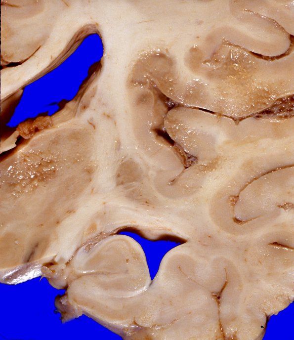 1A6 Metastases, diffuse, miliary, parenchyma and leptomeninges (Case 1) 5