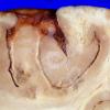 1A7 Metastases, diffuse, miliary, parenchyma and leptomeninges (Case 1) 2