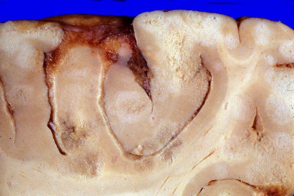 1A7 Metastases, diffuse, miliary, parenchyma and leptomeninges (Case 1) 2