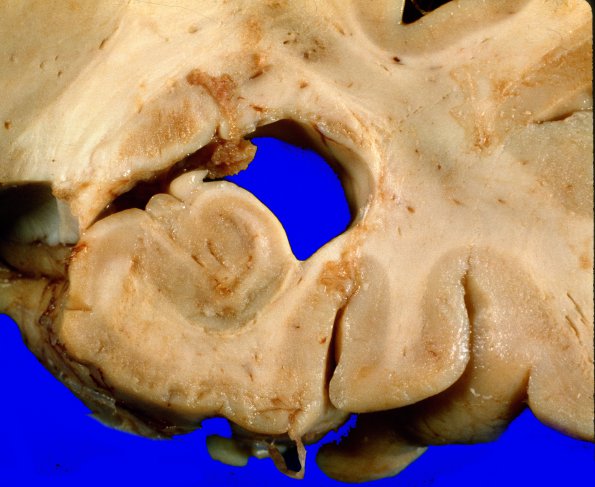 1A8 Metastases, Lung primary (Case 1) X 10