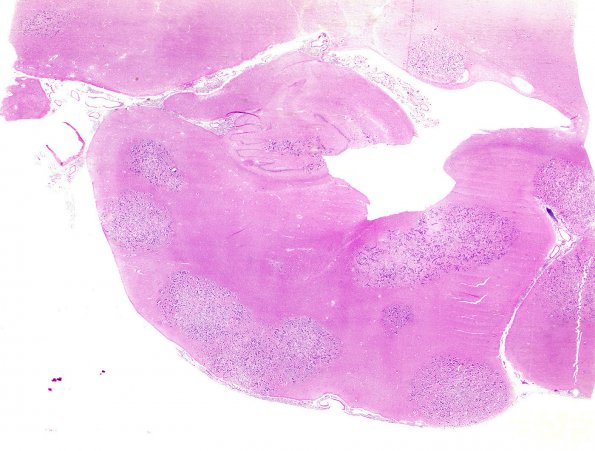 1B1 Metastases, diffuse, miliary, parenchyma and leptomeninges (Case 1) H&E 6 - Copy