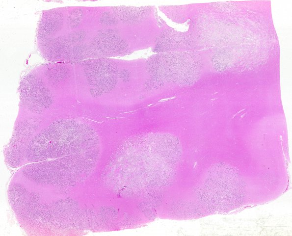 1B2 Metastases, Lung primary (Case 1) X 31