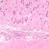 1B3 Metastases, Lung primary (Case 1) H&E 10X