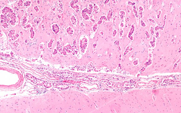 1B3 Metastases, Lung primary (Case 1) H&E 10X