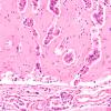 1B4 Metastases, Lung primary (Case 1) H&E 20X 2