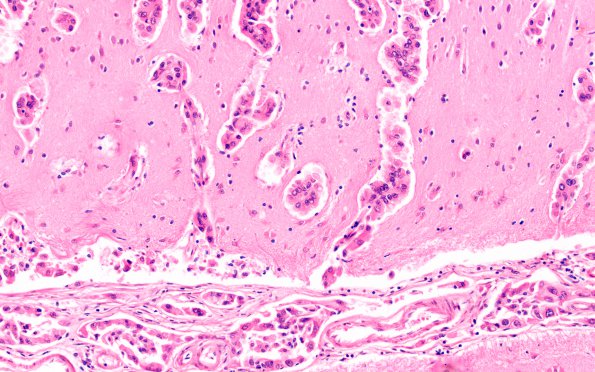 1B4 Metastases, Lung primary (Case 1) H&E 20X 2