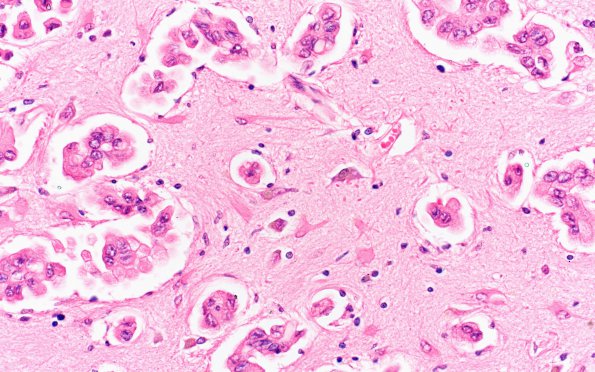 1B5 Metastases (Case 1) G H&E 40X 4