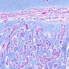 1C3 Metastases, Lung primary (Case 1) LFB-PAS 10X 2