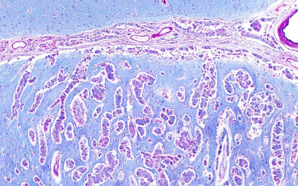 1C3 Metastases, Lung primary (Case 1) LFB-PAS 10X 2