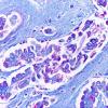 1C4 Metastases, Lung primary (Case 1) LFB-PAS 40X