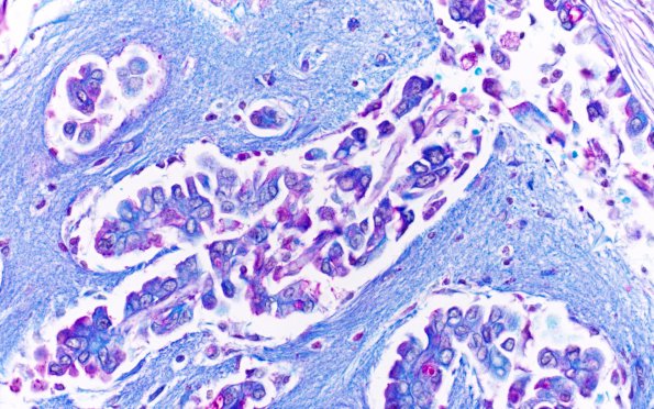 1C4 Metastases, Lung primary (Case 1) LFB-PAS 40X