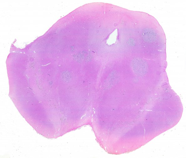 1D Metastases, Lung primary (Case 1) X 32