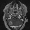 2A1 Metastasis, lung, leptomeningeal (Case 2) T1W - Copy - Copy