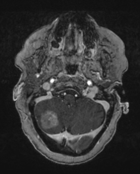 2A1 Metastasis, lung, leptomeningeal (Case 2) T1W - Copy - Copy