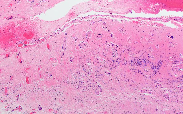 2B1 Metastasis, lung, leptomeningeal (Case 2) H&E 4