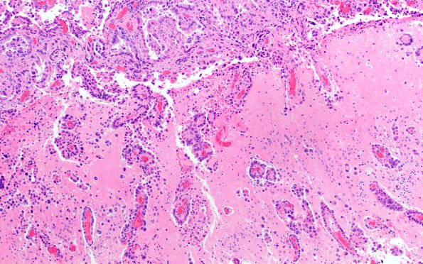 2B2 Metastasis, lung, leptomeningeal (Case 2) H&E 1