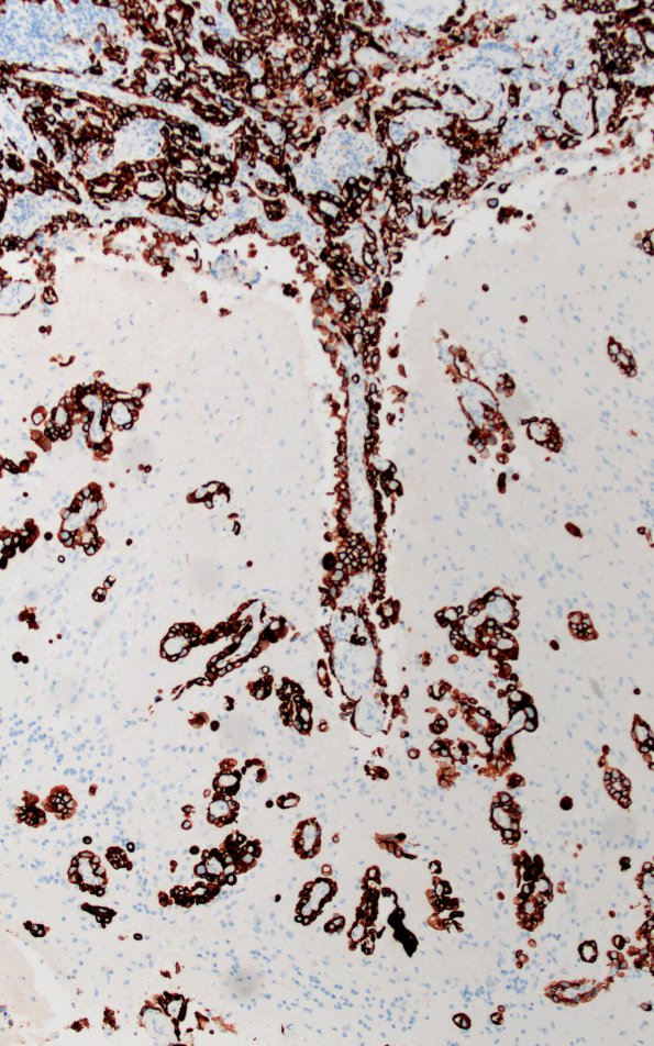 2C2 Metastasis, lung, leptomeningeal (Case 2) CK7 1