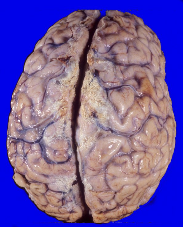 3A1 Carcinoma, renal, lepto (Case 3) 1