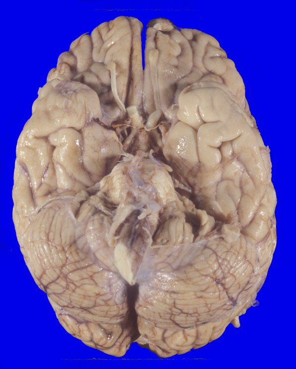 3A2 Carcinoma, renal, lepto (Case 3) 5