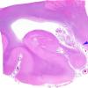 3B1 Carcinoma, renal, lepto (Case 3) N3 WM copy