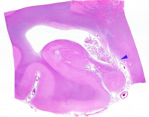 3B1 Carcinoma, renal, lepto (Case 3) N3 WM copy