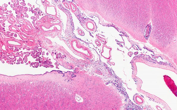 3B2 Carcinoma, renal, lepto (Case 3) N3 4X