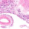 3B3 Carcinoma, renal, lepto (Case 3) N3 20X