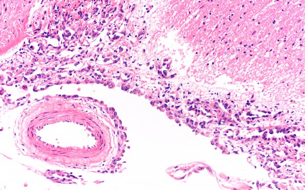 3B3 Carcinoma, renal, lepto (Case 3) N3 20X