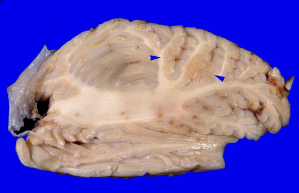 3C1 Carcinoma, renal, lepto (Case 3) 4 copy