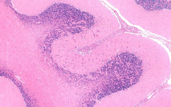 3C2 Carcinoma, renal, lepto (Case 3) N13 4X