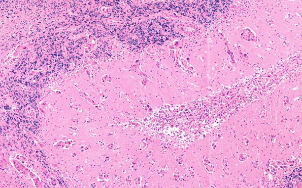 3C3 Carcinoma, renal, lepto (Case 3) N13 10X