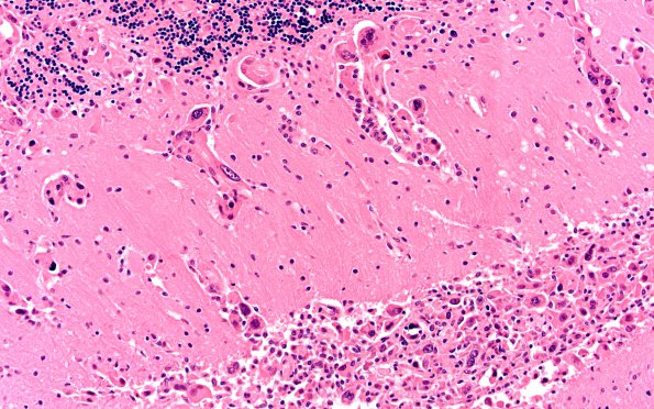 3C4 Carcinoma, renal, lepto (Case 3) N13 20X