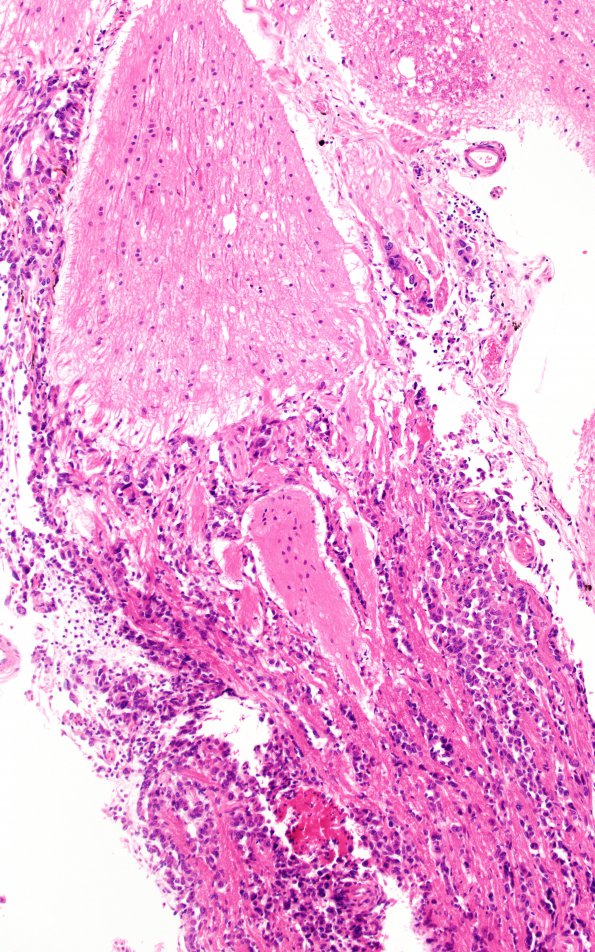 3D1 Carcinoma, renal, lepto (Case 3) N6 10X 3rd nerve A